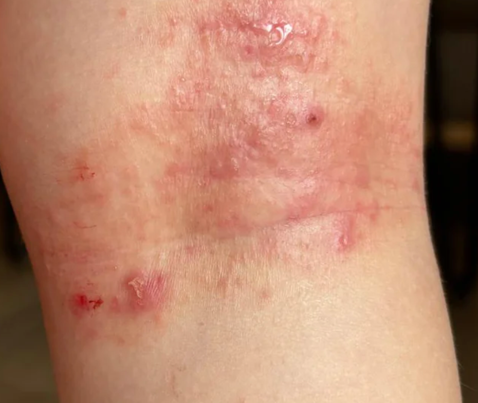 Neurodermitis bei Babys & Kindern: Was Eltern wissen sollten – Ursachen, Auslöser & was wirklich hilft